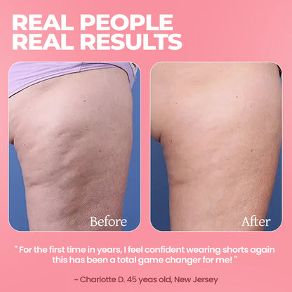 CelureSlim 12™ 2.0 Cellulite Massager