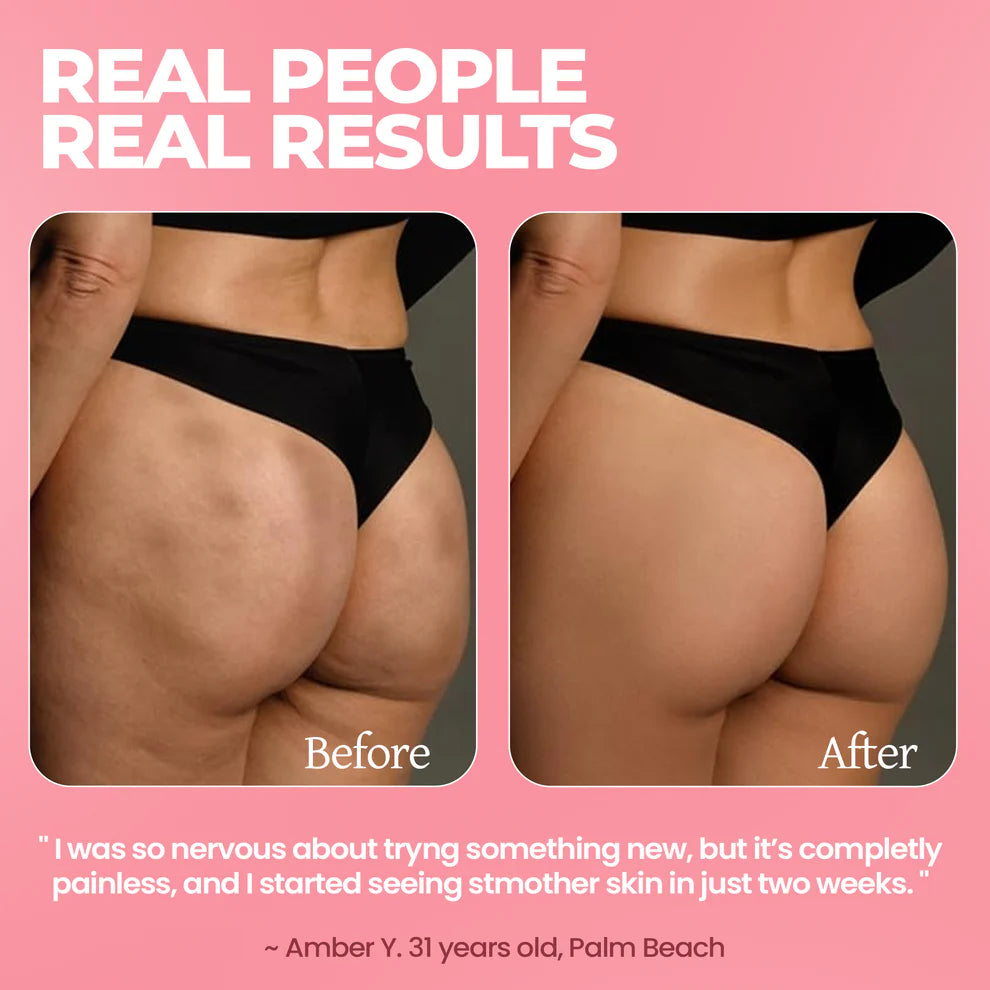 CelureSlim 12™ 2.0 Cellulite Massager